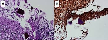 Image result for Kayexalate