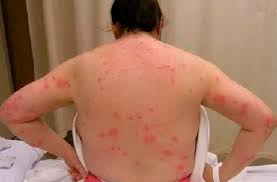 How To Deal With Flea Bites On Human And Understanding Flea Bites Images Flea Bites On Human Beings Are Ve Cure For Bed Bugs Bed Bug Bites Bed Bugs Treatment
