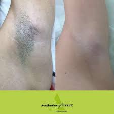 Pulsed light is used to impair the hair follicle. Laser Hair Removal Essex Aesthetics Of Essex