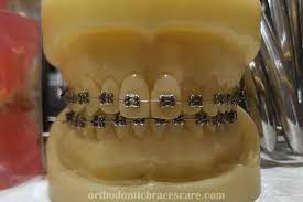 Rinse your mouth thoroughly with water after brushing with this paste. Why Are My Teeth Turning Yellow With Braces Orthodontic Braces Care