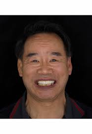 Changing lives, one smile at a time. #neworleansdentist #noladentist  #dentalimplants #implantdentures #hybriddentures #hybridprosthesis