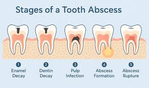 Image result for Periapical Abscess