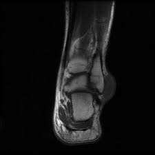 An ankle sprain usually happens when the foot inverts or rolls out, stretching or tearing the ligaments and tendons ankle pain which may difficult to pinpoint but somewhere just in front of the bony bit or lateral malleolus on the outside of the ankle. Subcutaneous Bursa Of Lateral Malleolus Radiology Case Radiopaedia Org