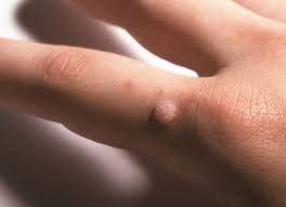 Human papillomavirus infection (hpv infection) is an infection caused by human papillomavirus (hpv), a dna virus from the papillomaviridae family. Hpv Und Warzen Infektionen Der Haut Mit Humanen Papillomaviren