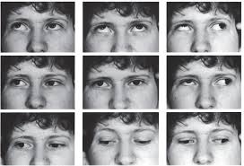 A Family with Bilateral Duane's Retraction Syndrome, Dominant Inheritance,  and Prominent Systemic Features