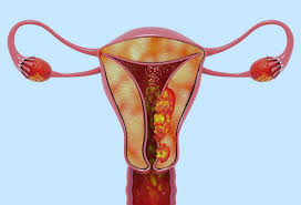 It's more common in women who have been through the menopause. What Are The Symptoms Of Uterine Sarcoma