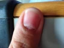 hilfe loch am nagelansatz nagelkrankheiten