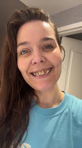 Full dental implants healing process and cost