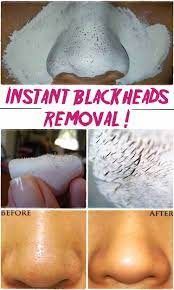Say Goodbye To The Unpleasant Blackheads By Clearing Your Skin With This Simple Homemade Mask Diy S Trucos De Belleza Tratamientos De Belleza Consejos D