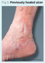 Venous Leg Ulcer Prevention 1 Identifying Patients Who Are At Risk Nursing Times