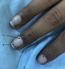 Terry's Nails in a Child - The Journal of Pediatrics