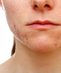 The area around the mouth is subjected to deal with the outside environment more than any other part of the face, which. How To Get Rid Of Chin Acne