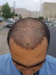 After 10 Days Hair Transplant Laser Clinics Hair