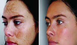 Types Of Chemical Peels For Acne Meaning Before And After Pictures Chemical Peel Acne Hyperpigmentation Treatment Natural Skin Lightening