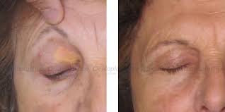 Image result for xantelasma