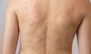 Acne Mechanica Caused By Skin On Skin Friction