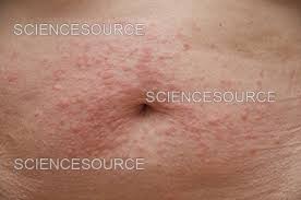 Image result for Polymorphous Light Eruption