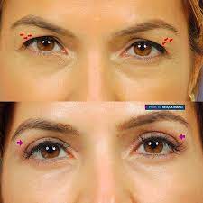 Prof Dr Selcuk Inanli Rinoplasti Instagram Photos And Videos Rinoplasti Gozler Kader