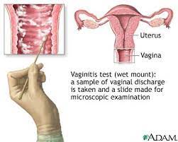 Treatments to cure trichomoniasis infection include antibiotics. Diagnostic Test