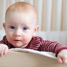 Dr. Erick Cabrera Buendia • Alergia e Inmunología Clínica