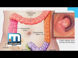 This guide gives you all the more details about the symptoms of colon cancer. Colorectal Cancer Causes And Treatment Doctor 2pm Mathrubhumi News Youtube