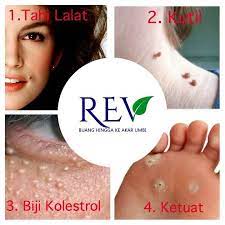 Tetapi pengalaman membuktikan itu semua tidak benar. Tahi Lalat Ketuat Kutil Biji Kolesterol Rev Publicaciones Facebook