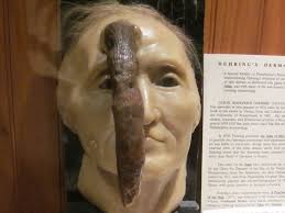 Dr. Thomas Dent Mütter (1811-1859)