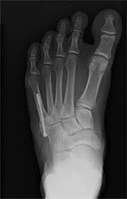 The jones fracture surgery generally involves the placement of plates or screws down the shaft of the fifth metatarsal bone. Fifth Metatarsal Fracture Surgery Footcaremd