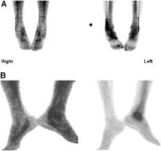 Image result for Osteomyelitis Bone Scan