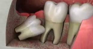 Wisdom Teeth Removal Extraction Impaction Wisdom Teeth Wisdom Teeth Removal Impacted Wisdom Teeth