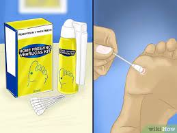 What is the treatment for warts on hands? 5 Ways To Remove Verrucas Wikihow