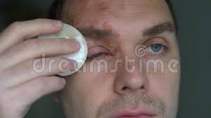 Infektion orsakad av tarmparasiter (t.ex. Herpes Zoster Paverkat Hanansikte Purulosa Blister Pa Framhuvudet Stock Video Video Av Smittsamt Klia 168368773