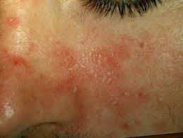 Check spelling or type a new query. Malassezia Hefen Und Ihre Bedeutung In Der Dermatologie Springerlink