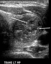 • thyroid nodules are common, but nodules with concerning findings by ultrasound, such as hypoechogenicity, irregular or infiltrative margins, microcalcifications, and increased intranodular. Thyroid Uss