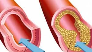 Meski kadang penderita kolesterol tinggi mengeluhkan beberapa hal seperti leher tegang, kram menurut dr. Waspadalah 4 Gejala Kolesterol Tinggi Ini Datangnya Tak Terduga