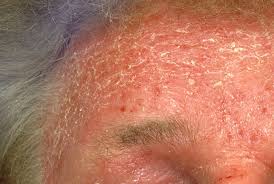 Image result for ekzema face