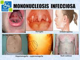La mononucleosis infecciosa es una enfermedad provocada por un virus de la familia de los herpes. Pin En Exantematicas