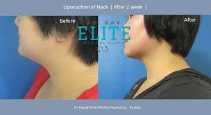 Call now · more info. Best Botox Liposuction Dr Ray Medical Aesthetics Rocklin