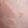 Anaphylaxis usually develops suddenly and gets worse very quickly. Https Encrypted Tbn0 Gstatic Com Images Q Tbn And9gcquxw7lxh8zqsu36xc Vhaatnccn9w V0xwraneesuc53kkvoi6 Usqp Cau