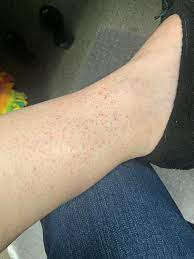 What Is This These Red Spots Will Randomly Show Up On Both Ankles Every Few Months And Last For A Week Or Longer Not Raised Don T Itch And Don T Line Up With