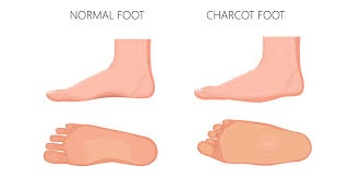 Focus on your feet charcot foot, also called charcot arthropathy, is a disease that attacks the bones, joints, and soft tissue in your feet. Diabetes Charcot Foot Syndrome Foot Health Clinic Samford Village Qld