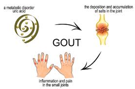 Image result for Hyperuricemia