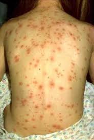 Image result for chickenpox