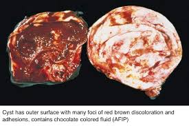 The information provided on this page is based upon 39 cases of lesions fully or partially within the liver tissue (parenchyma). Pathology Outlines Endometriosis