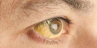 Maybe you would like to learn more about one of these? 6 Cara Memutihkan Mata Kuning Secara Alami Cepat Dan Mudah Merdeka Com