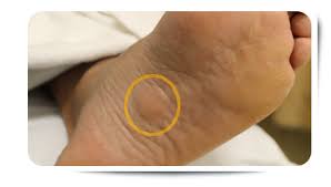 Sharp, burning or shooting pain near your toes (ball of your foot), feels like a lump or small stone under your foot. Pin On Fit At 50