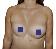 Syndrom poaborcyjny to dość częste następstwo usunięcia ciąży. Treatment Of Breast Asymmetry Anatomikmodeling