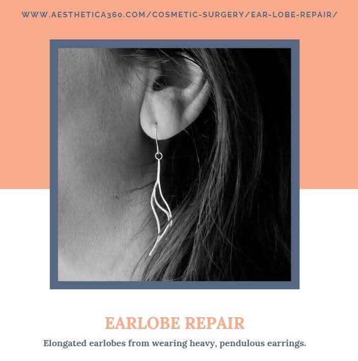 Earlobe Repair product image