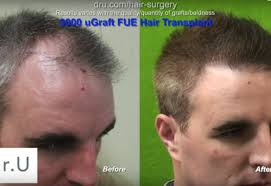 Click to see full answer. Is Hair Loss A Sign Of Aging