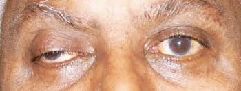 Image result for Pupillary Paralysis